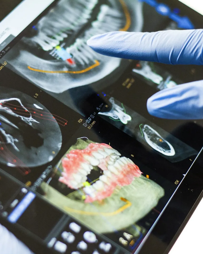Planning an implant on a digital X-ray