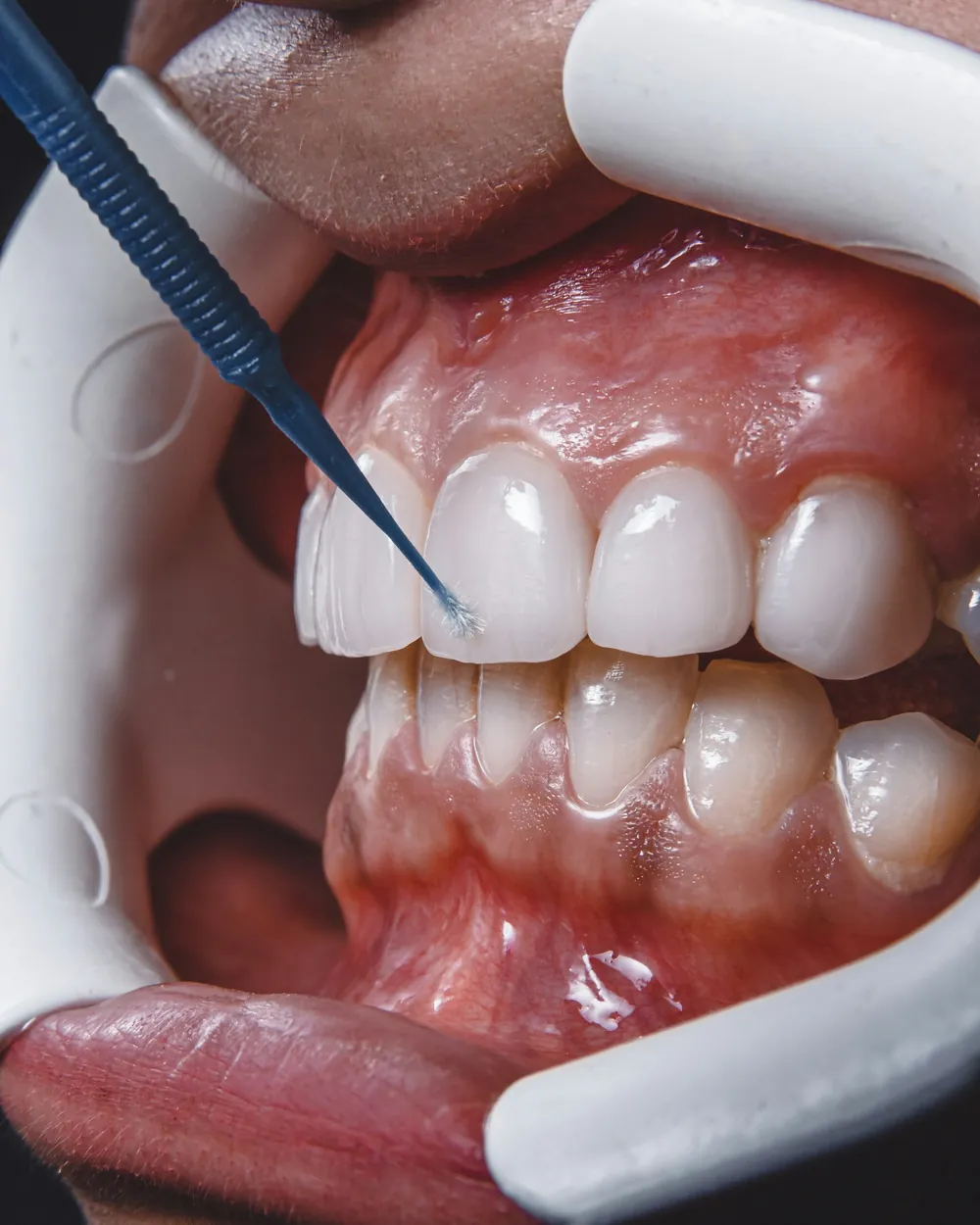 Gum examination with a periodontal probe