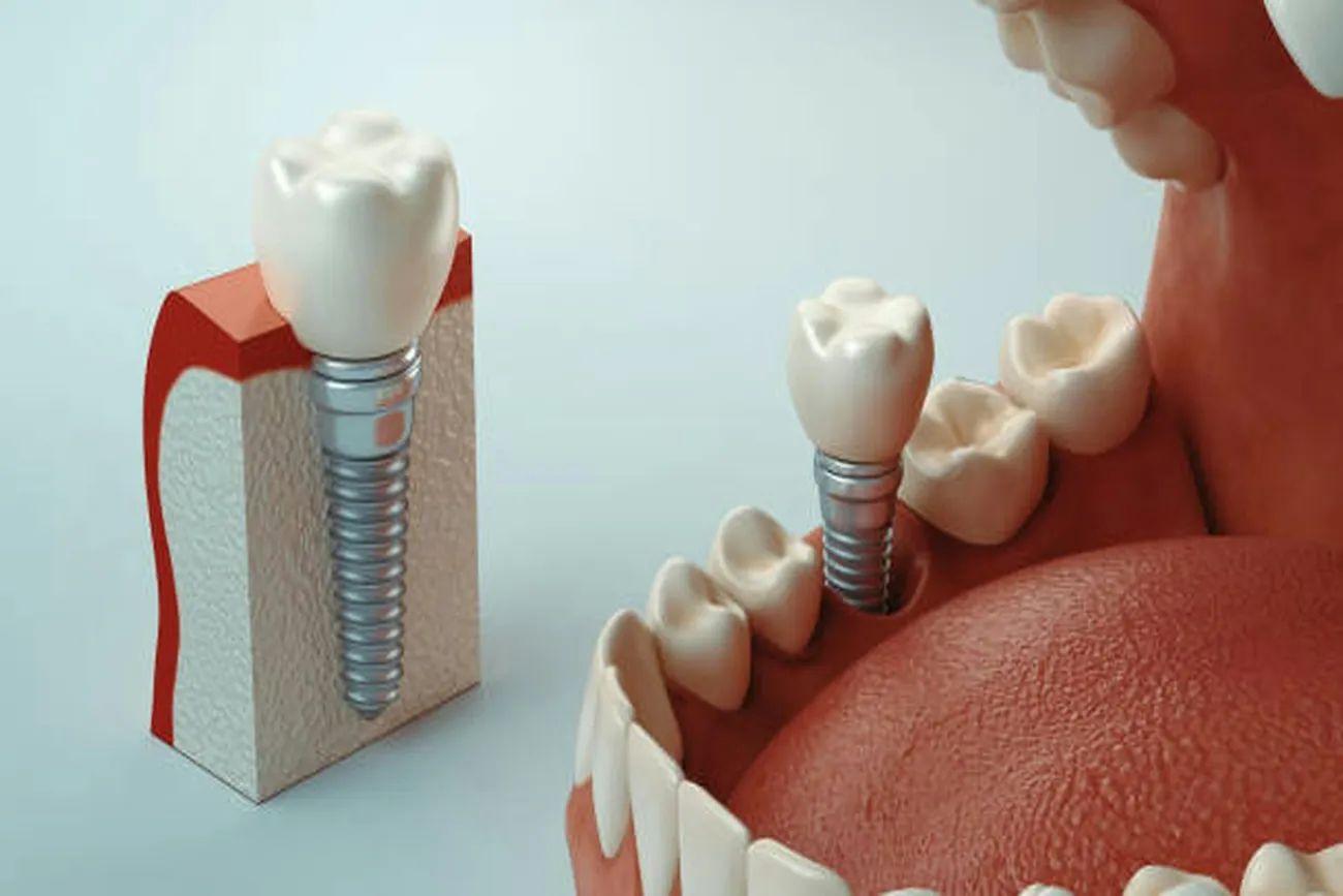 Model of a dental implant and crown in the jaw